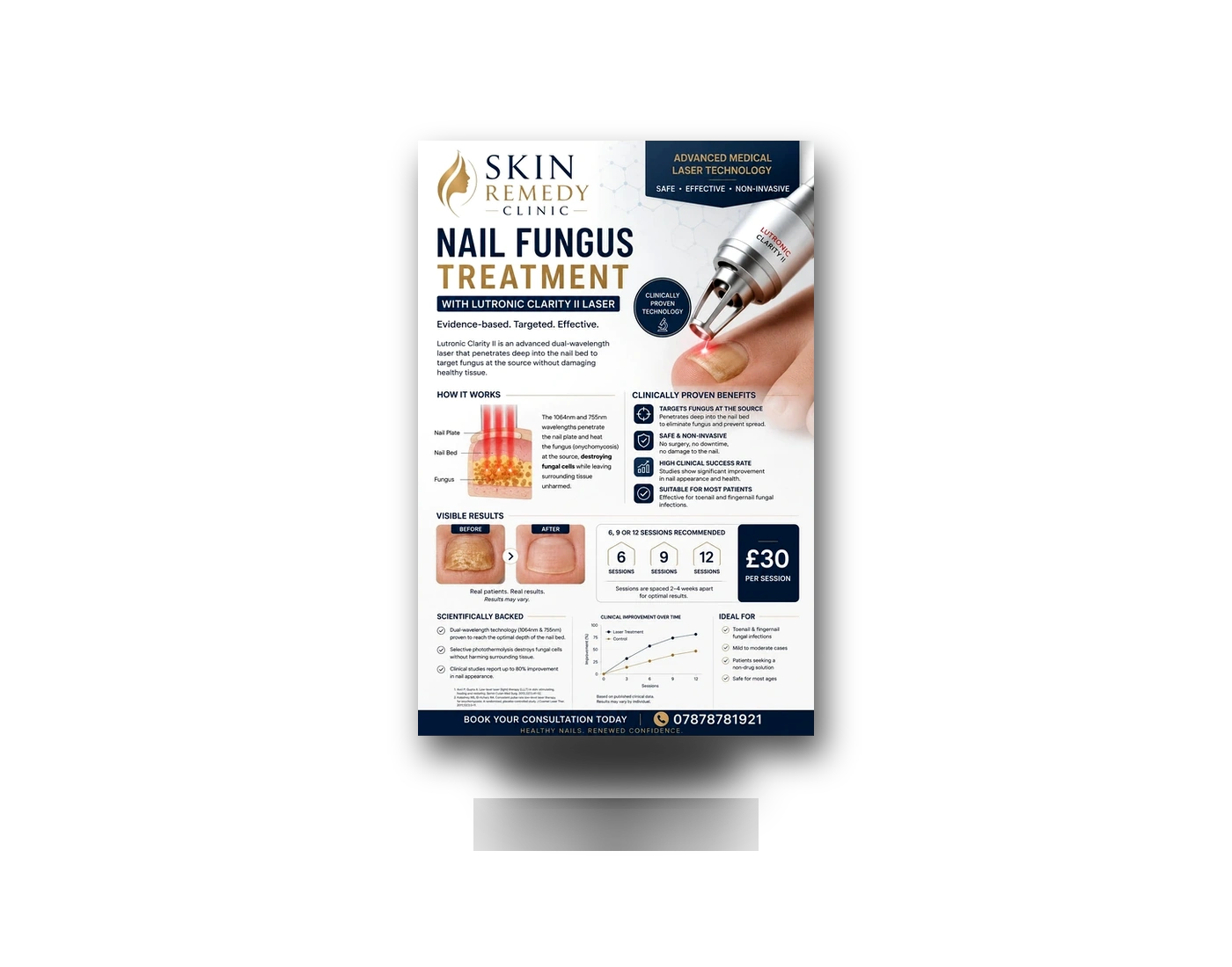 Nail Fungus Laser Support packaging or clinic stock image